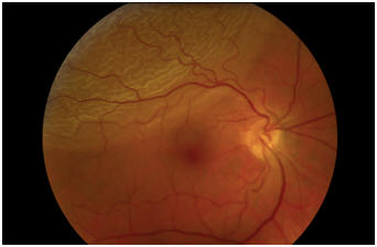 Retinal detachment